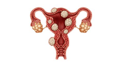 Uterine fibroids: Symptoms and treatment | Nebraska Medicine Omaha, NE