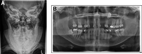 Transoral Approach to Open Reduction of a Traumatic Avulsion Fracture ...