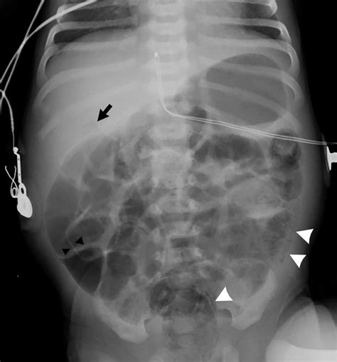 Rumbly in the tumbly: Pneumatosis intestinalis and necrotizing enterocolitis | Radiology Key