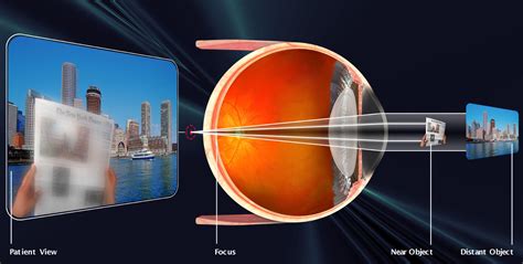 Presbyopia - Innovative Eye Care