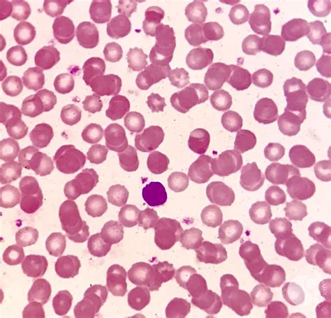 Peripheral blood film shows normal RBC density with normocytic ...