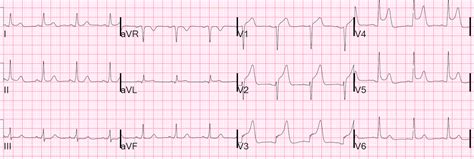 Dr. Smith's ECG Blog: Transient STEMI, no T-wave Evolution and no Wall ...