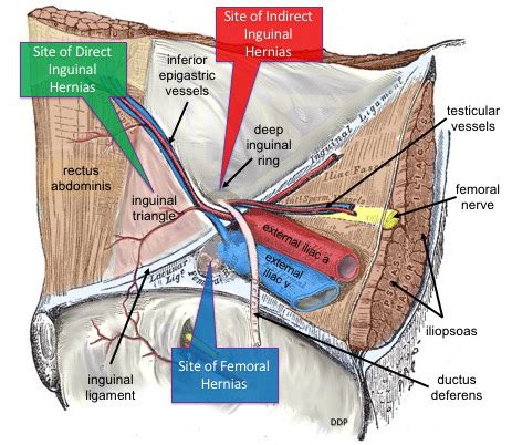 Direct Hernia vs Indirect Hernia – Moosmosis