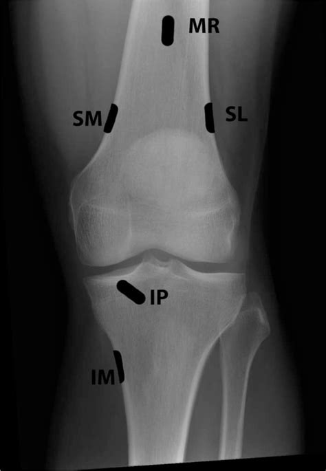 Fluoroscopic Guided Knee Genicular Nerve Block - Technique and Overview - The Procedure Guide