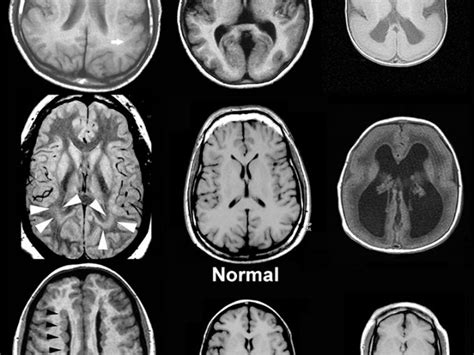 Stabilized epilepsy in three adult cases of pachygyria – Making ...