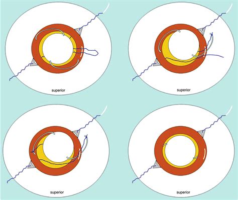 (A) The PC IOL is placed in the anterior chamber through the pupil and... | Download Scientific ...