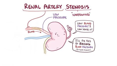 Renal Artery Stenosis Possible Causes Symptoms And Tr - vrogue.co