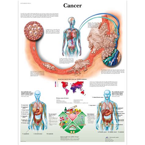 Colorectal Cancer Chart