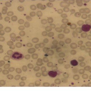 Peripheral blood smear showing normocytic normochromic anemia with no... | Download Scientific ...