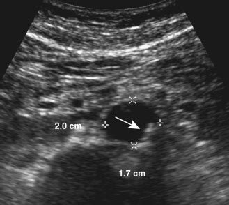 Abdominal Aorta Ultrasound