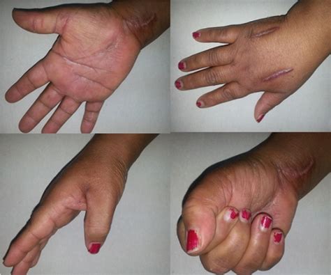 Good finger mobility and a disappearance of paresthesia | Open-i