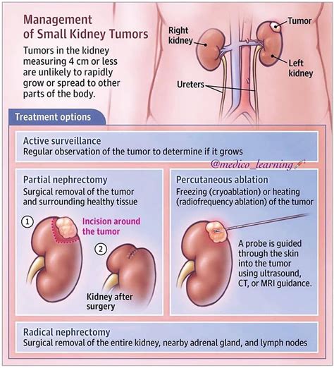 Read More and Download Book immediately Management of Small Kidney Tumour . . . #medico #medical ...