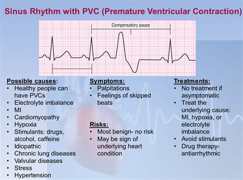 Sinus with PVCs