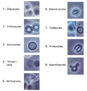 The Acanthocyte - Renal Fellow Network