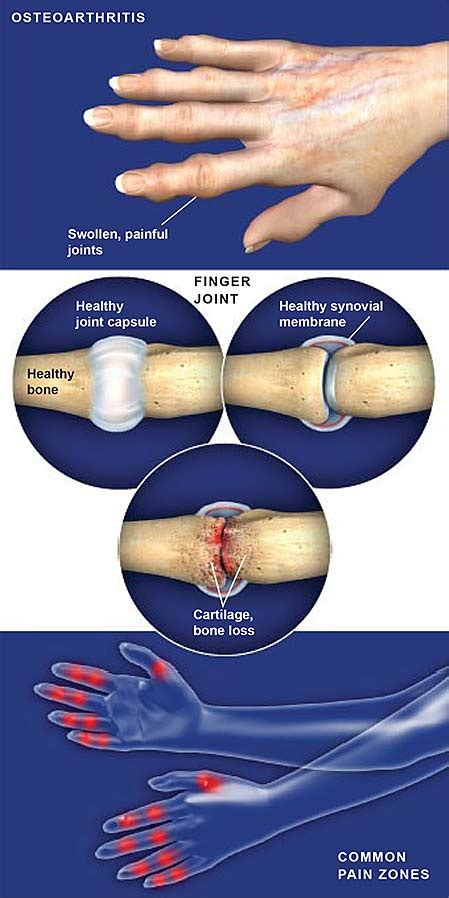 Osteoarthritis of the Hand | Central Coast Orthopedic Medical Group