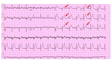 Cureus | Atypical de Winter Presentation of Critical Left Anterior ...