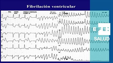 Taquicardia: La fibrilación ventricular, caos y shock - YouTube