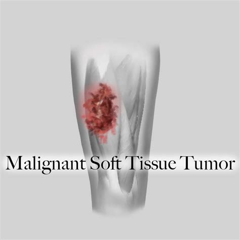 MSK Tumor | THERAPEUTICAL AND RESEARCH CENTER OF MUSCULOSKELETAL TUMOR