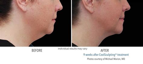 CoolSculpting Chin Fat | CoolSculpting Double Chin