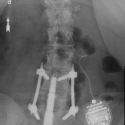 Revision Surgery after Failed Axialif | Houston Scoliosis & Spine Institute