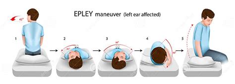 Epley Maneuver Left Ear Affected Vector Illustration Stock Vector - Illustration of head, bppv ...