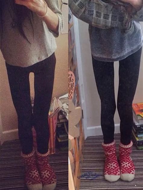 Woman obsessed with 'thigh gap' developed anorexia after she exercised three times a day to lose ...