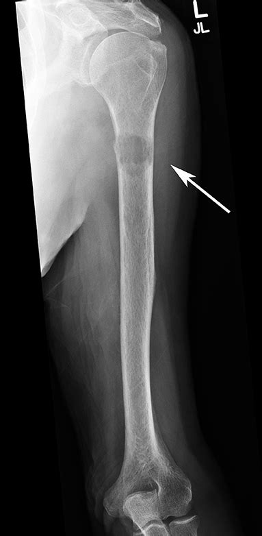 Frontiers | Multimodal Treatment of Bone Metastasis—A Surgical Perspective | Endocrinology