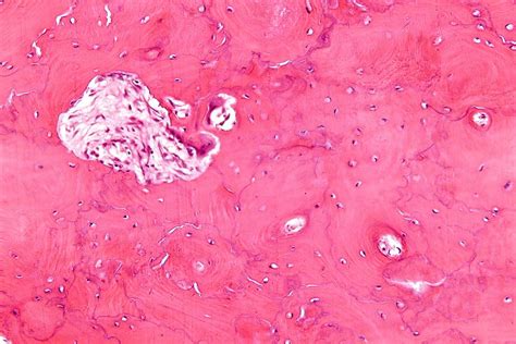 Paget Disease of Bone - USMLE Strike