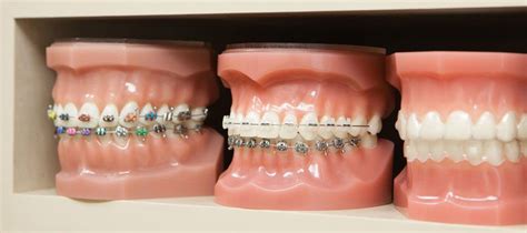 Types of Dental Braces - How & Who Makes Them?