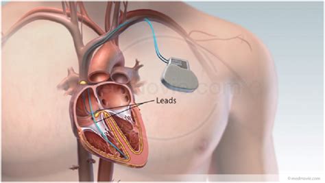 Pacemaker Implantation | Heart Rhythm Clinic