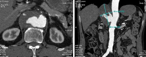 VIETNAMESE MEDIC ULTRASOUND: CASE 565: SUPRARENAL AORTIC ANEURYSM, Dr ...