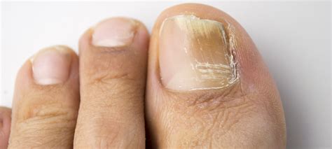 How to Treat Toenail Fungus