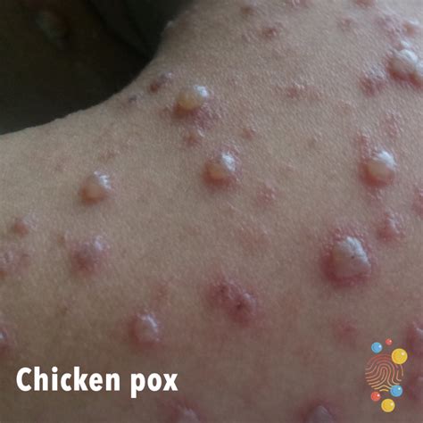 Chicken pox - Skin Deep