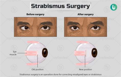 Strabismus (squint) surgery: Procedure, Purpose, Results, Cost, Price, Indications, Recovery