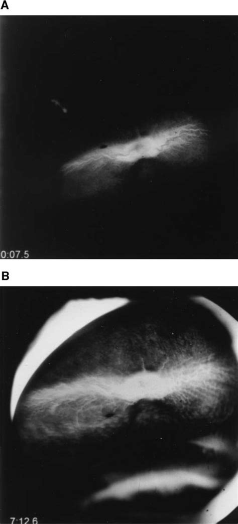 Fluorescein angiography performed after the end of the procedure.... | Download Scientific Diagram