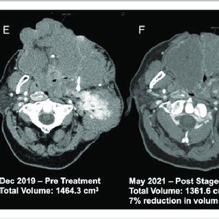 (A-D) Comparison of CT soft tissue neck with contrast imaging at ...