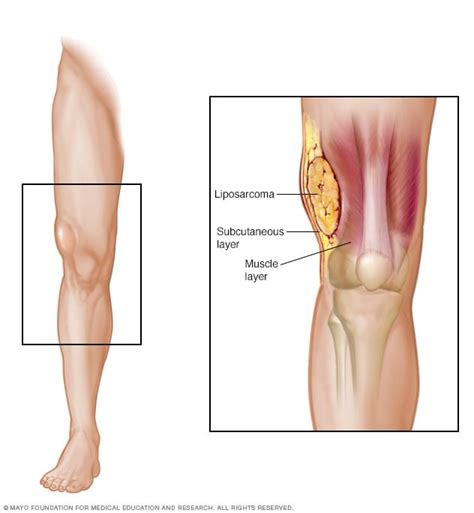 Liposarcoma - Síntomas y causas - Mayo Clinic