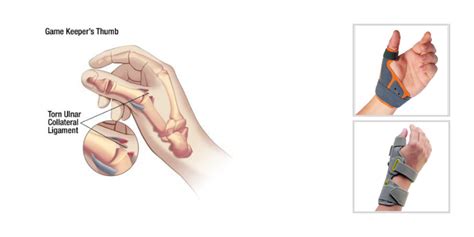 Ulnar Collateral Ligament Thumb Splint