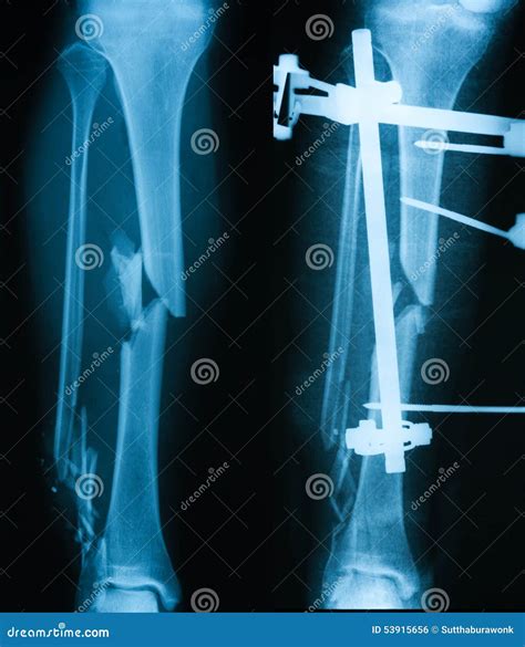 X-ray Image Of Broken Leg, AP View. | CartoonDealer.com #53915656