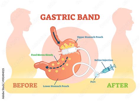 Gastric Band anatomical vector illustration diagram, medical before ...