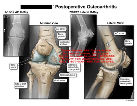 AMICUS Illustration of amicus,surgery,knee,postoperative,osteoarthritis ...