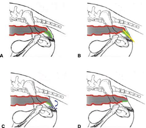 Figure 3 from A fistula flap technique for correction of type II ...