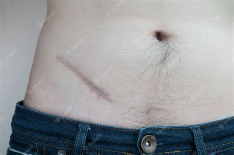 Premium Photo | Scar from operation suture, lesions from appendicitis surgery.