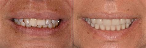 All-on-4 ® Dental Implants Photos | Miami | Patient 12642