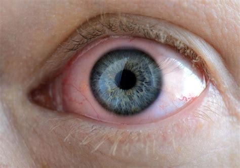 What are Gonococcal and Chlamydial Conjunctivitis?