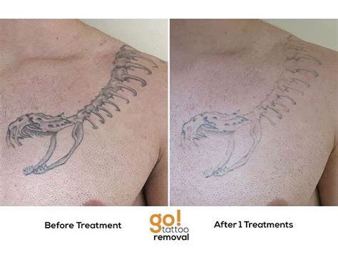 GO! Tattoo Removal • A single @PicoSure treatment has made a pretty...