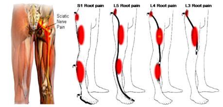 Chiropractic Treatment Of Sciatica or Leg Pain - Accent on Health ...