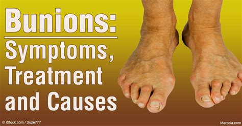 Bunions: Causes, Symptoms and Treatment