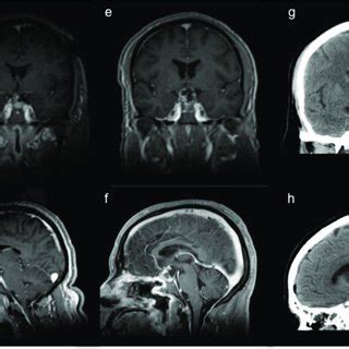 Ommaya reservoir placement for cystic recurrence. A 52-year-old male ...