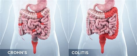 What Is The Difference Between Crohn's Disease And Ulcerative Colitis? - GI